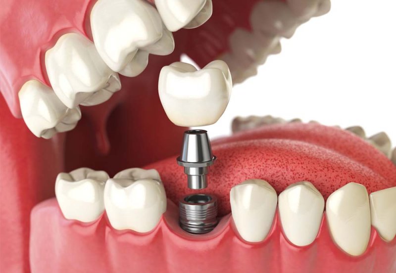 Prótese e Implantes Dentais