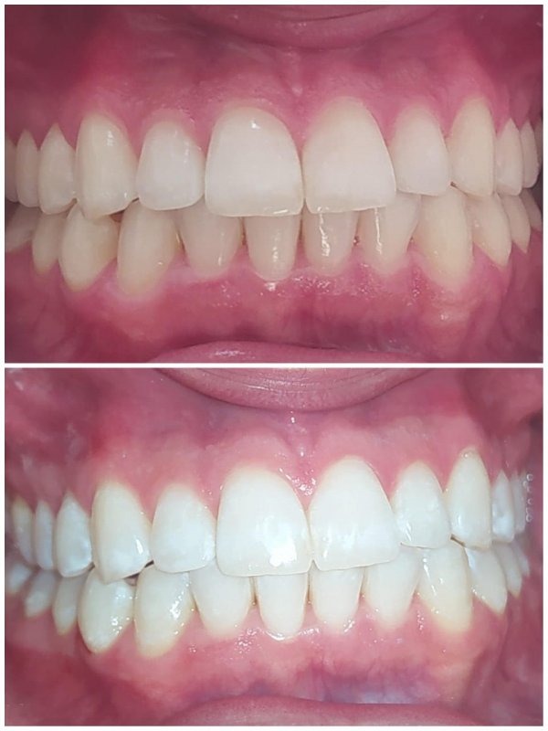 Clareamento Dental